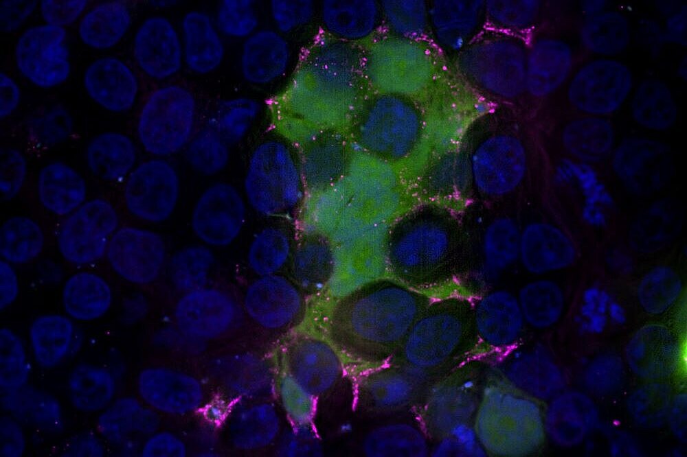Mikroskopisches Bild von mit RSV infizierten Zellen. Grün: Mit GFP markiertes RSV-F-Protein im Zytoplasma der Zellen, Magenta: RSV-F-Protein, Blau: Zellkerne.