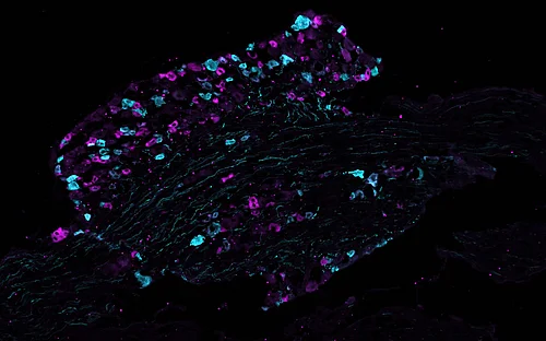 First “protein map” of neurons that initiate pain