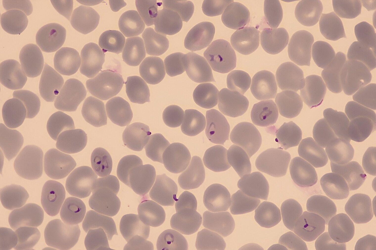 Lichtmikroskopie von roten Blutzellen, einzelne mit Plasmodium infiziert