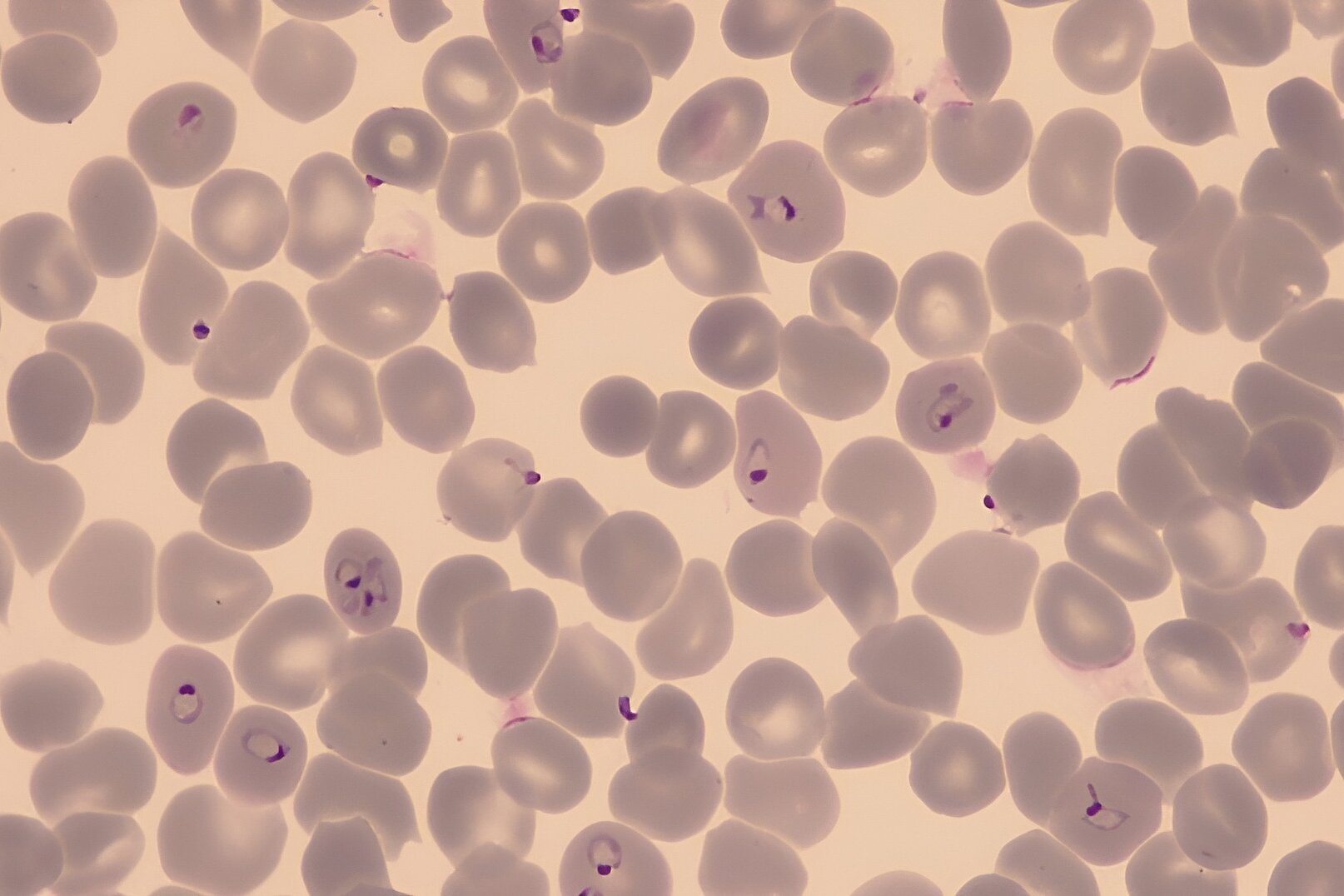 Lichtmikroskopie von roten Blutzellen, einzelne mit Plasmodium infiziert