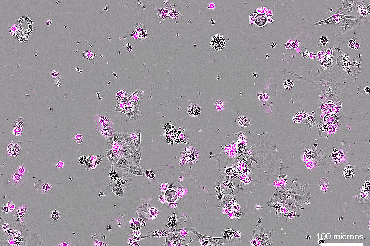 Light microscope image of cervical cancer cells with magenta stainings