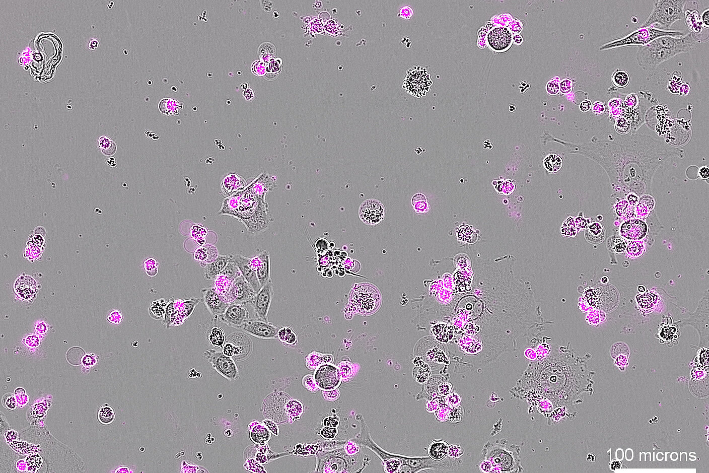 Light microscope image of cervical cancer cells with magenta stainings