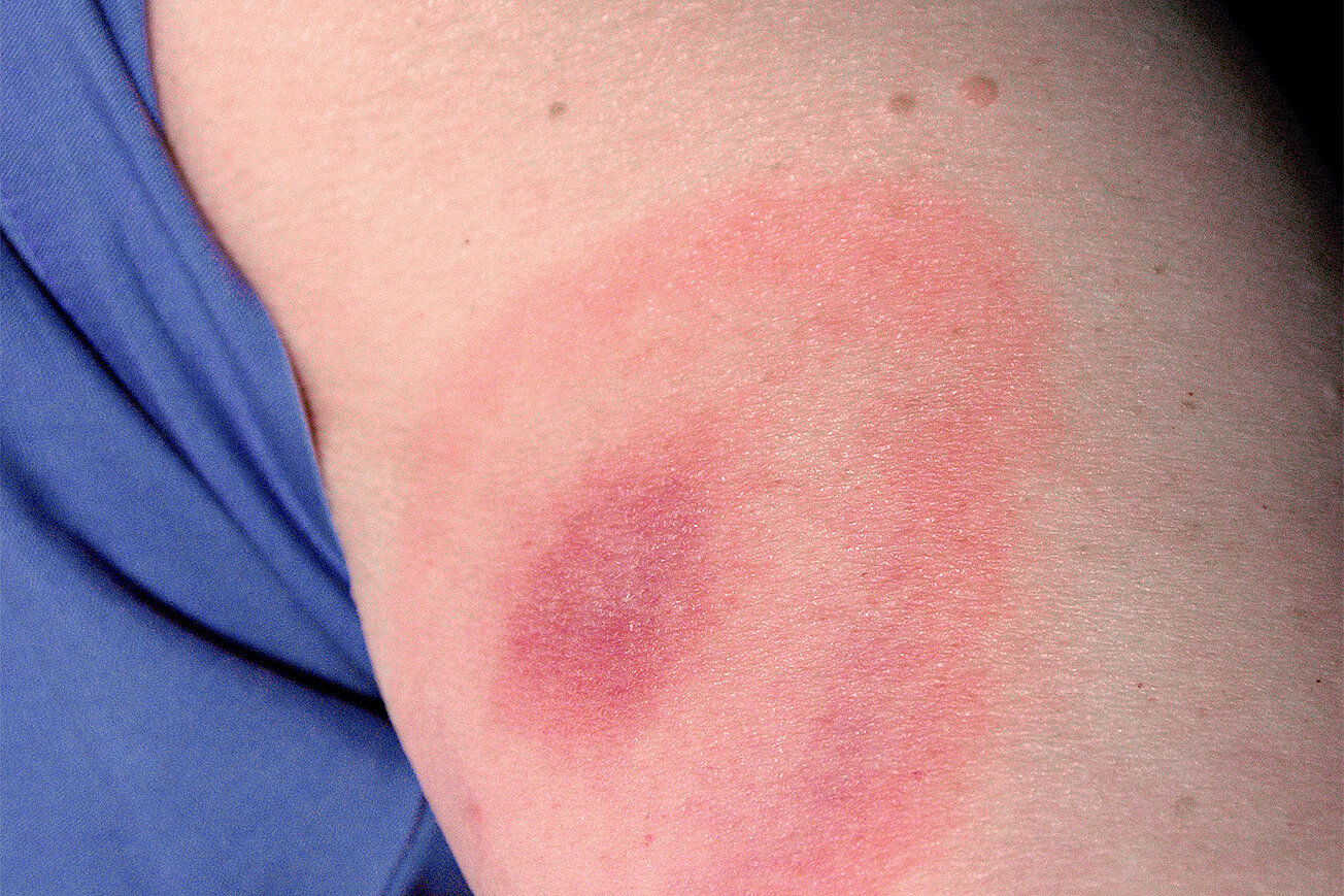 Arm with erythema due to Borrelia infection