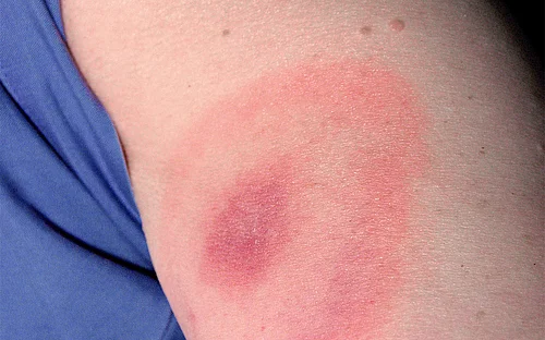 Borreliose: Erkrankungswahrscheinlichkeit genetisch veranlagt