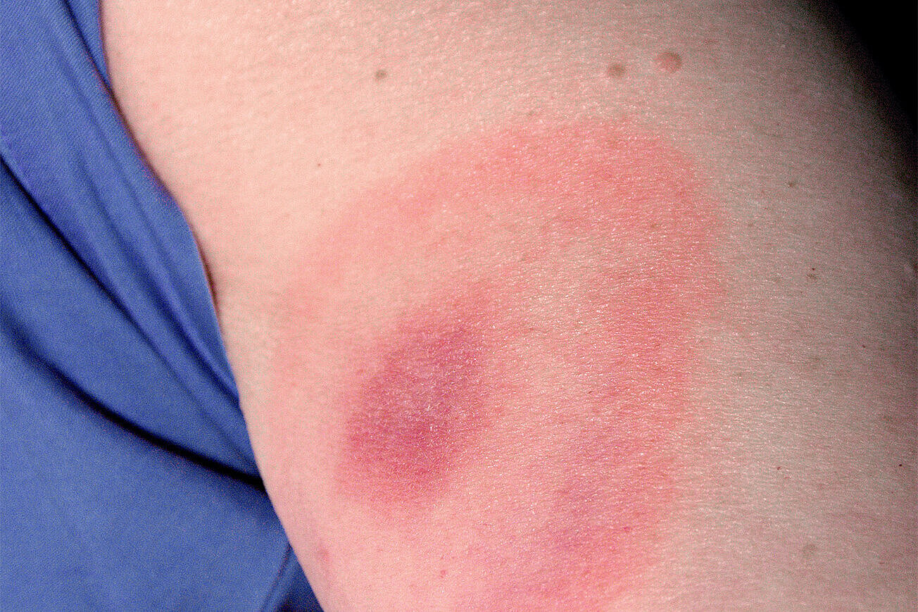 Arm mit Wanderröte durch Borrelien-Infektion