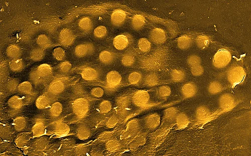 New agent inhibits Staphylococcus aureus toxin – hope for pneumonia patients