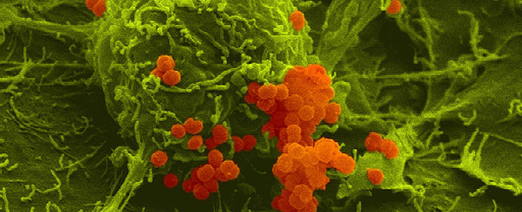 Meningokokken (orange) haben sich an menschliche Wirtszellen (grün) angeheftet. Rasterelektronenmikroskopische Aufnahme in Falschfarbendarstellung. 